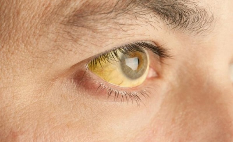 لکه‌های زرد چشم نشانه چیست؟