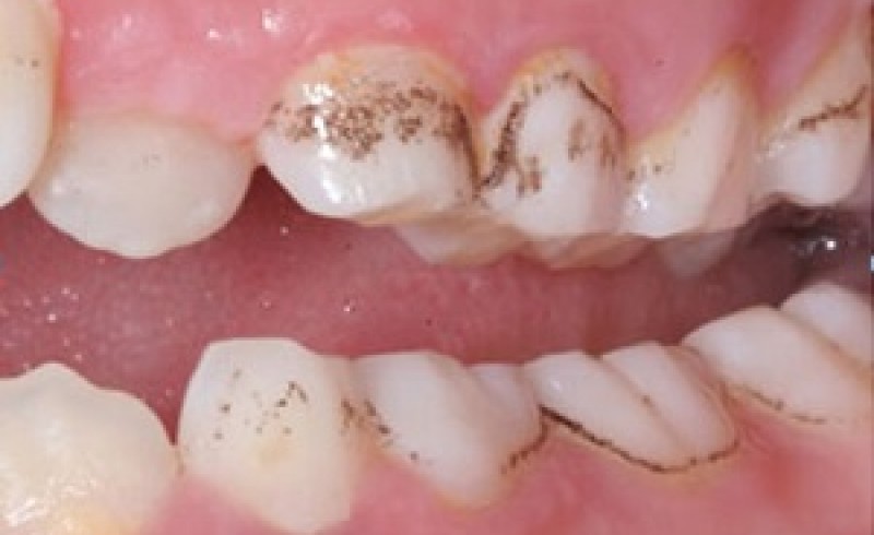 آیا قطره آهن دندان کودک شما را پوسیده و خراب می‌کند؟