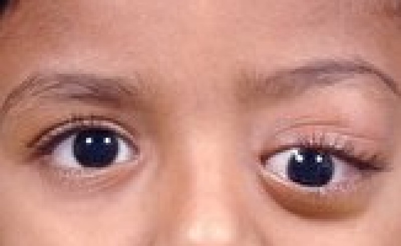 هر آنچه باید از علل ابتلا به تنبلی و انحراف چشم بدانید/ کدام کودکان به تنبلی چشم دچار می‌شوند؟