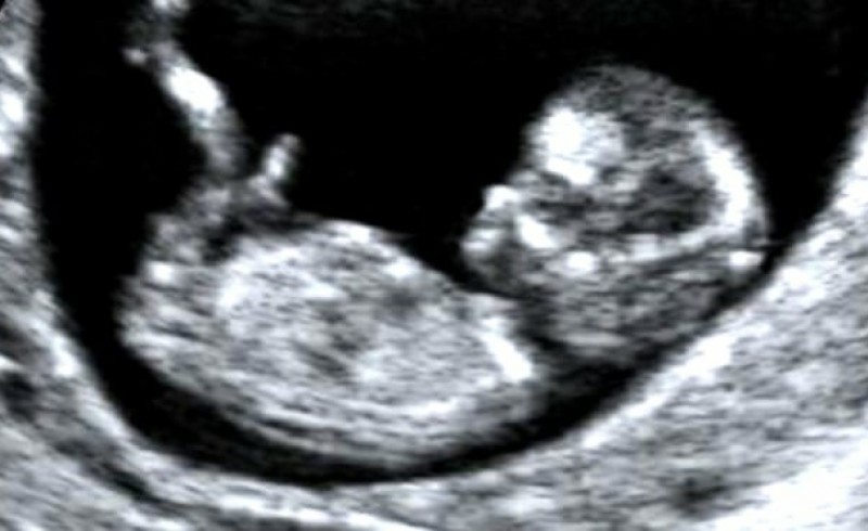 سونوگرافی از جنین برای یادگاری، ممنوع