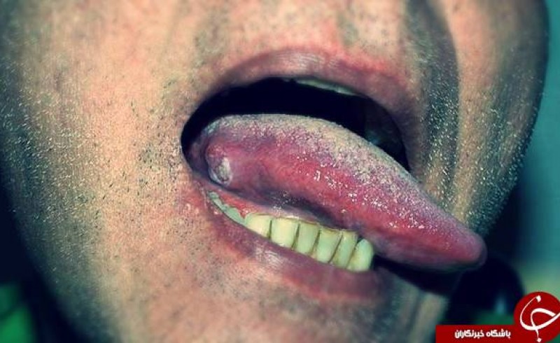 سرطان زبان چه نشانه‌هایی دارد؟! / خالی که از سرطان زبان خبر می‌دهد!