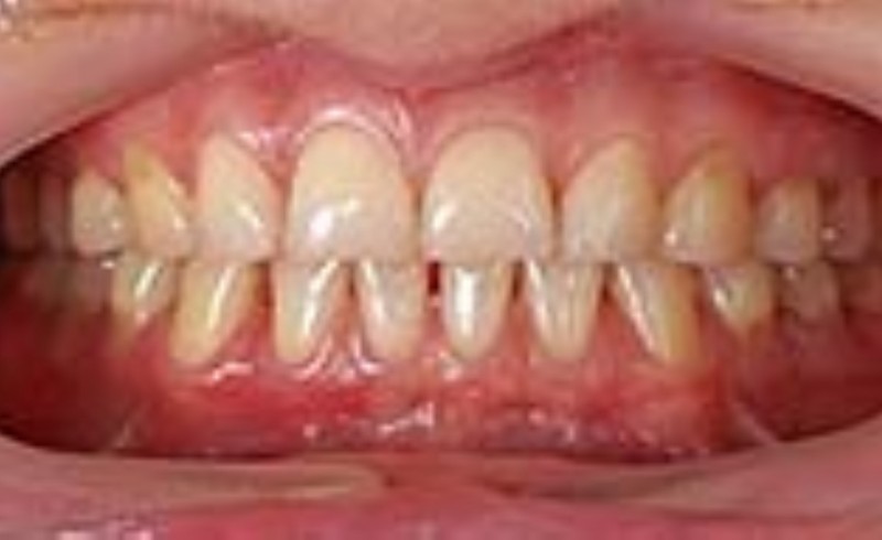 ارتباط ۹۰ درصد بیماری‌های لثه با رعایت نکردن بهداشت دهان و دندان