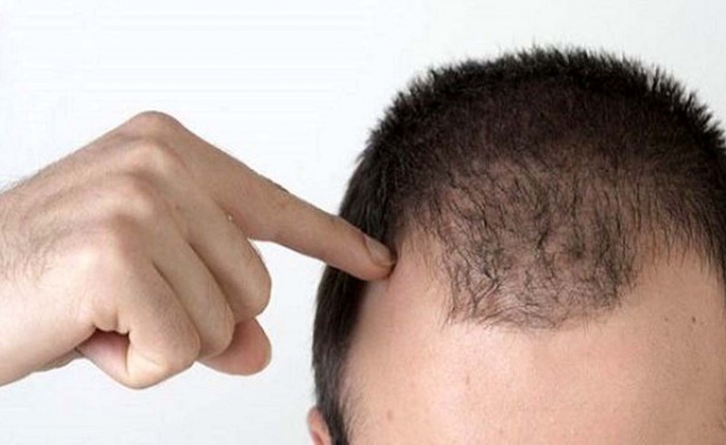 روش هایی برای جلوگیری از ریزش مو در آقایان